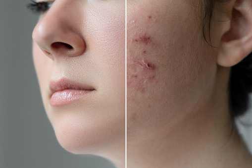Use this diet to get pimple free skin naturally