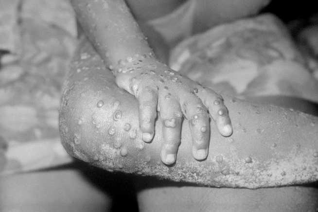 5 things to know about monkey pox